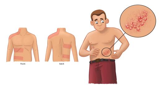 ما هو لقاح الحزام الناري وكيف يعمل