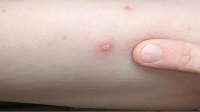 أسباب انتشار جدري القرود بأوربا بحسب ما أدلت به الصحة العالمية