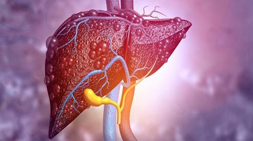 ثورة طبية.. علاج أورام الكبد من خلال الموجات فوق الصوتية